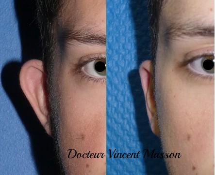 Otoplastie (oreilles décollées) avec earfold