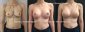 breast augmentation paris