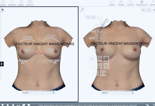 avant après réalité virtuelle