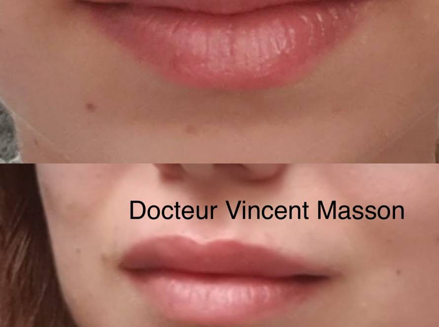 Augmentation volume des ;lèvres par injections botox ou acide hyaluronique