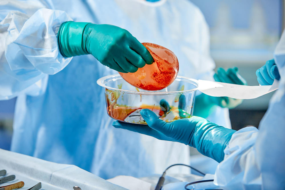 retrait de prothèse après augmentation mammaire ratée