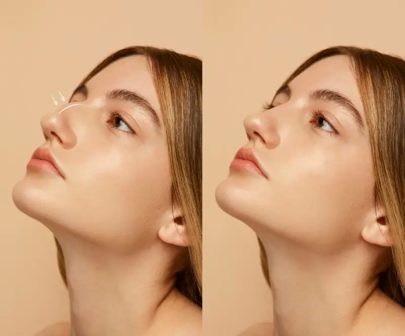 femme ayant une asymétrie du nez